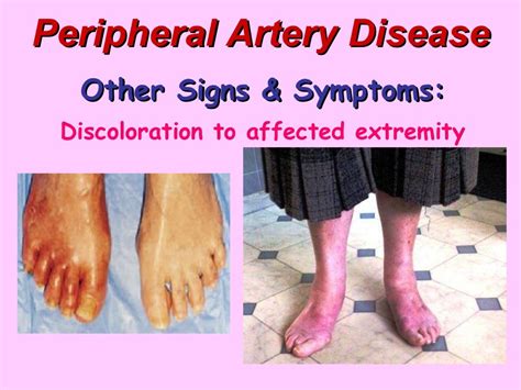 Peripheral Artery Disease - BMH/Tele