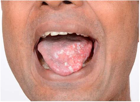 Squamous Cell Carcinoma Of The Tongue In A Patient With Dyskeratosis Congenita A Rare Entity