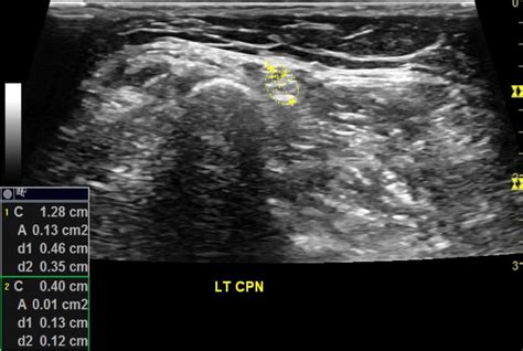 Figure 13 From Ultrasound Guided Nerve Hydrodissection For Pain Management An Updated Review Of