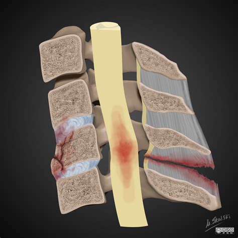 Flexion Teardrop Fracture Illustration Image