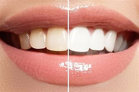 Everything You Need To Know About Teeth Whitening News Of The North