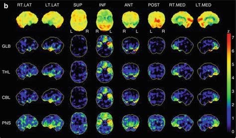 Principles Of Brain Perfusion Spect Radiology Key