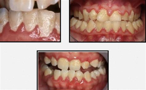 Plaque Calculus And Gingivitis Flashcards Quizlet
