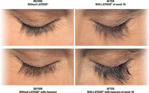 LATISSE® Eyelash Growth in California | Enhance Volume