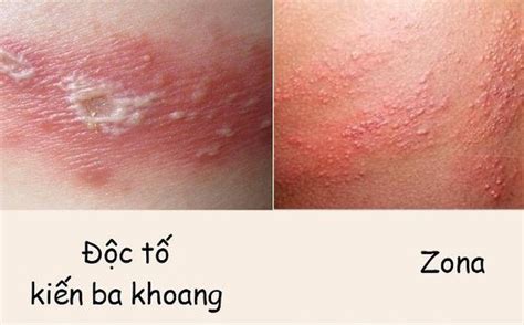 Kiến ba khoang cắn và 10 vấn đề liên quan bạn CẦN BIẾT - Tri Thức Việt