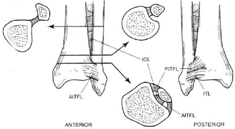 Schematic Drawing Of Distal Tibiofibular Syndesmosis With Atifl Il