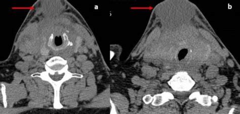 ANAPLASTIC THYROID CANCER: A CASE SERIES WITH A WIDE SPECTRUM OF ...