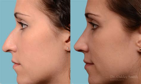 Rhinoplasty Ontario Dr Oakley Smith Surgeon