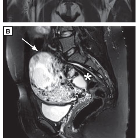 T Weighted Magnetic Resonance Images Of Cornual Ectopic Pregnancy And