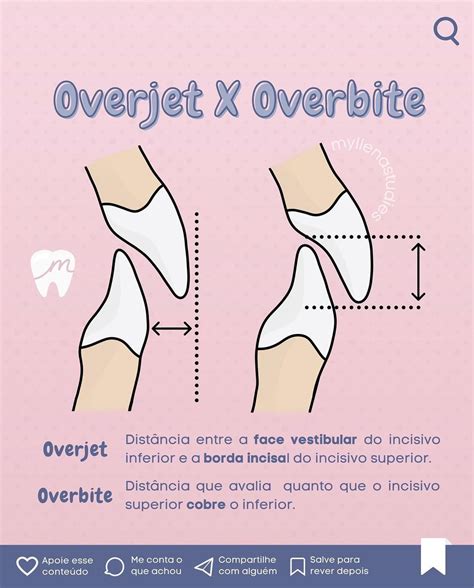 Myllena Amaral ODONTOLOGIA On Instagram Overjet X Overbite