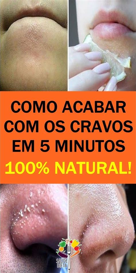 Como Acabar Os Cravos No Rosto Em Minutos Cravos E Espinhas