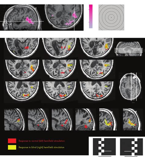 Functional Magnetic Resonance Imaging Fmri Activations For Motion And