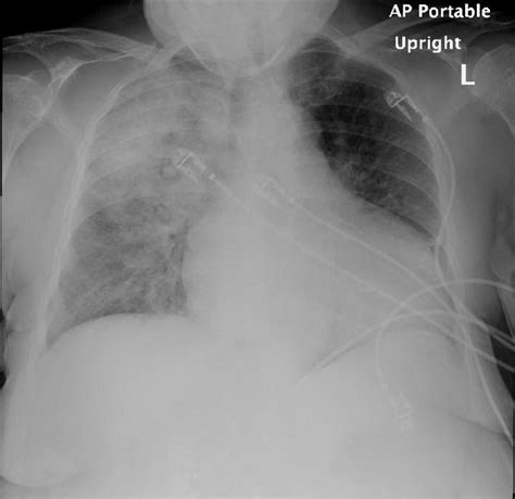 Chest Radiograph Showing Right Upper Lobe Opacity With Bilateral