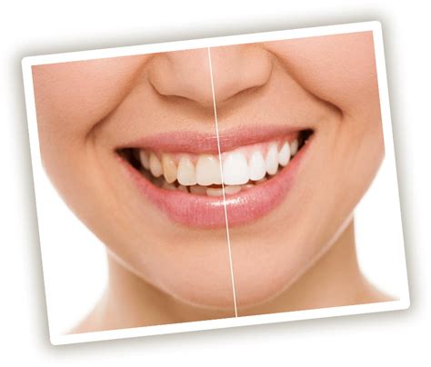 The Best Teeth Whitener Laser Teeth Whitening Vs At Home Whitening