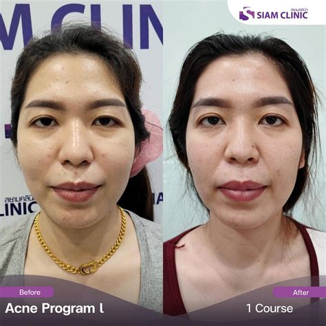 Acne Treatment Before and After Photos - Siam Clinic Thailand