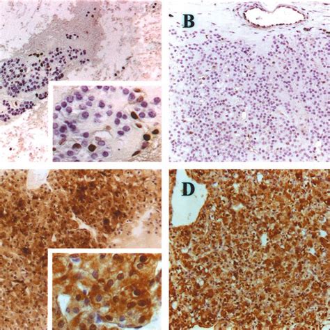 Galectin 3 Immunolocalization In Follicular Thyroid Adenoma A And C