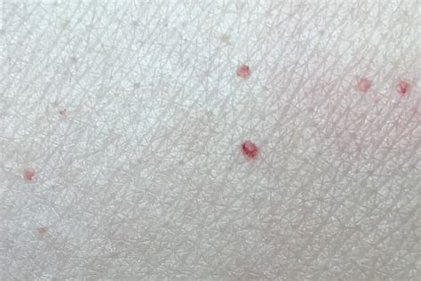 What Causes Red Blood Moles