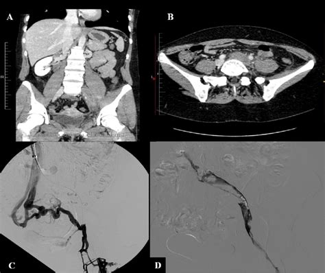 A Ct Scan Shows Compression And Thrombosis Of Left Common Iliac Vein