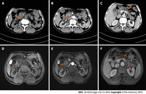 Pancreatic Pseudoaneurysm Mimicking Pancreatic Tumor A Case Report And