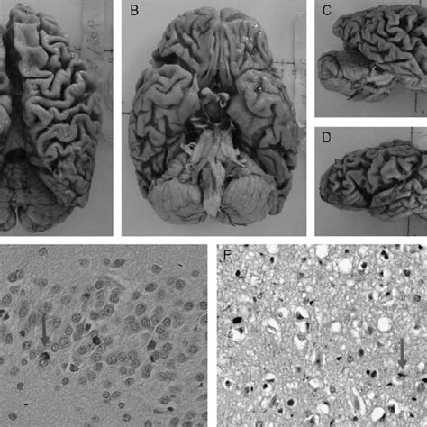 Cortical Atrophy In Subgroups Of Patients With Frontotemporal Lobar