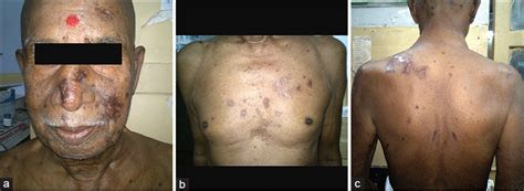 Co Reactivation Of Varicella Zoster Virus And Herpes Simplex Virus With