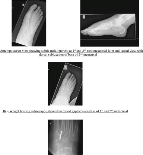 Pre And Post Operative Radiographs Of Patient With Missed Lisfranc Download Scientific Diagram