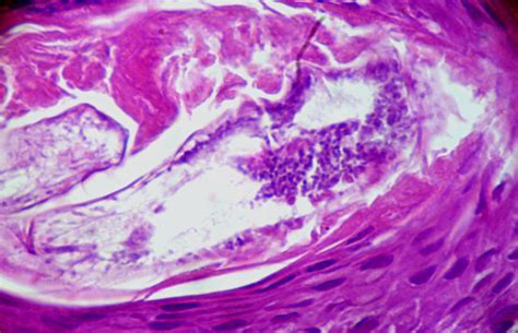 Demodex folliculorum | High power view of Demodex folliculor… | Flickr
