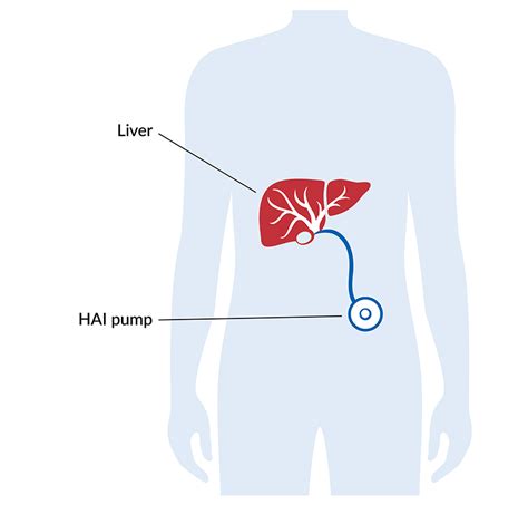 Hepatic Arterial Infusion Hai Ohsu