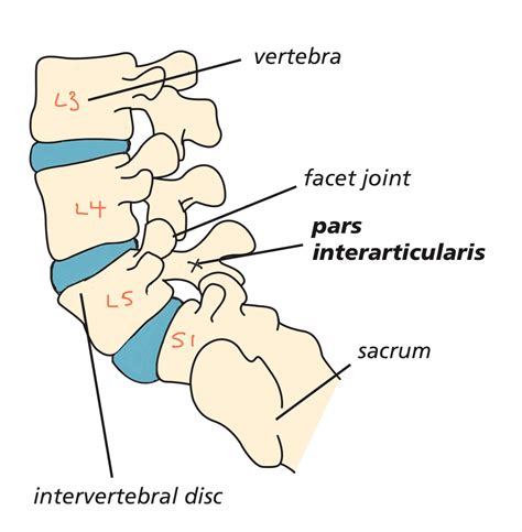 Pars Defect - Spines Dorset