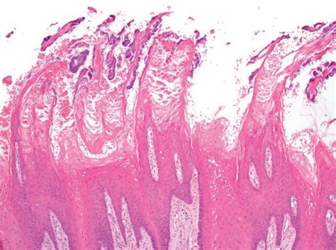 Hairy Tongue Histopathology Medizzy