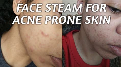 Face Steaming For Acne Prone Skin Youtube