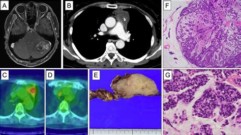 Stk Lkb Mutation Positive Primary Thymic Mucinous Adenocarcinoma