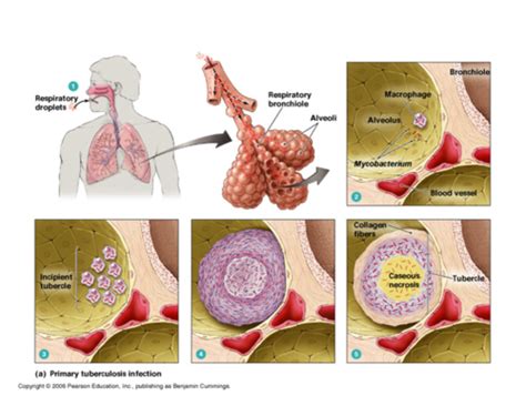 Tuberculosis Flashcards Quizlet