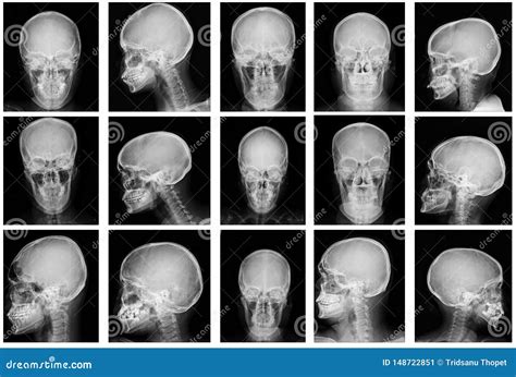 Collection Of Skull X Ray Image Of Human Skull Ap Lateral And Water