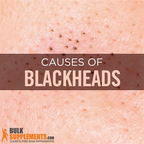 What are Blackheads: Causes, Characteristics & Treatment