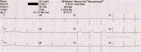 Normal 12 Lead Ecg Guru Instructor Resources