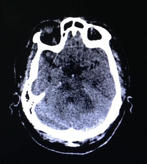 Liga Paraibana De Neurointensivismo Trombose Da Art Ria Basilar