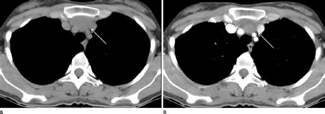 Figure From Anterior Mediastinal Bronchogenic Cysts Manifesting As A