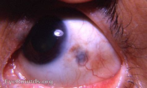 Scleral Diseases