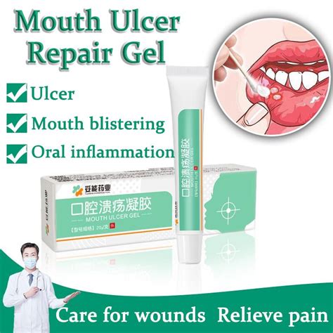 Mouth Ulcer Gel Oral Ulcer Gel Ubat Ulser Mulut 20g On Fire Mouth The