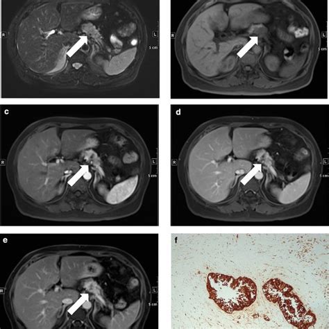 A 59 Year Old Female With Pdac Of The Pancreatic Body A E Arrow