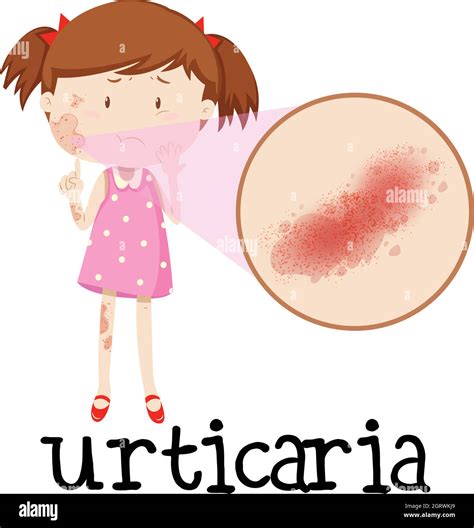 Urticaria Fotos E Imágenes De Stock Alamy