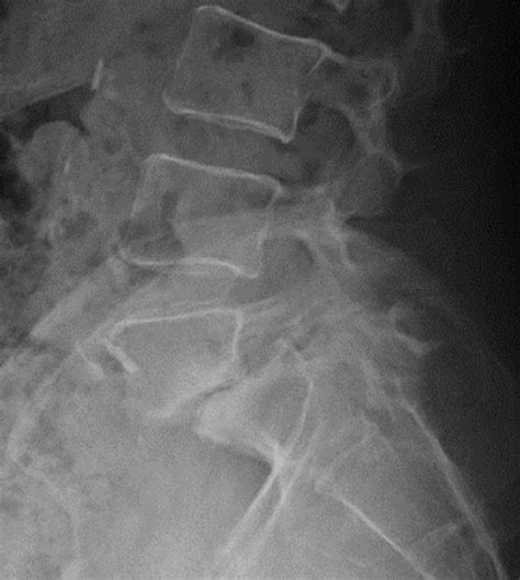 Spondylolisthesis L5 S1