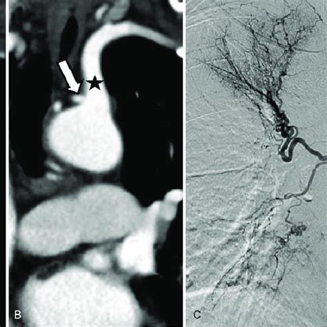 Ectopic Bronchial Artery From Left Subclavian Artery A B Chest Ct