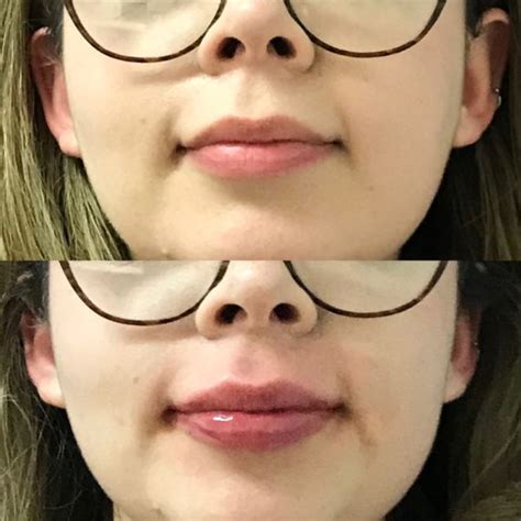 Restylane Kysse Lip Fillers In Santa Rosa And Healdsburg