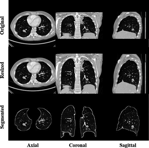 Deep Convolutional Neural Networks For Multiplanar Lung Nodule