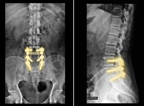 Anterior Lumbar Interbody Fusion ALIF