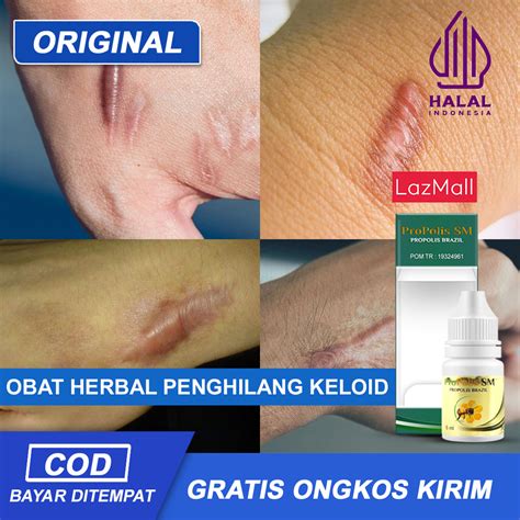 Obat Penghilang Keloid Keloid Daging Tumbuh Keloid Menahun Penghilang Bekas Luka Obat Keloid