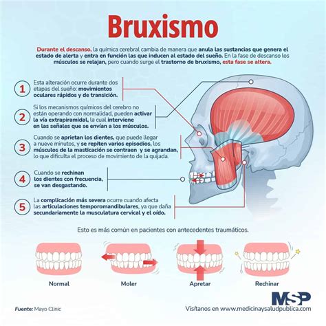 Bruxismo Infografía