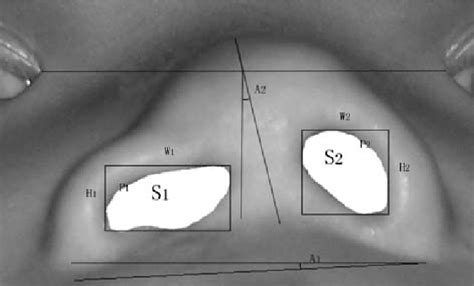 Figure 1 From Objective Measurements For Grading The Nasal Esthetics On Basal View In